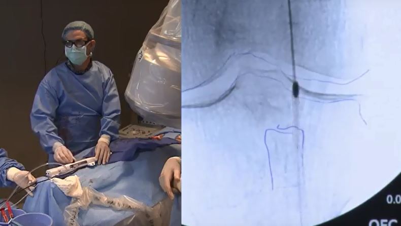 Watch Dr LeSar use Peripheral Rotablator in the Popliteal Artery.